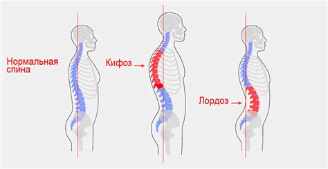 Грудная кифоз: симптомы и лечение