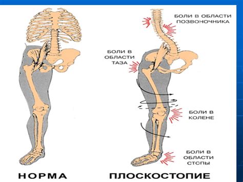Осколчатая осанка: диагностика и коррекция