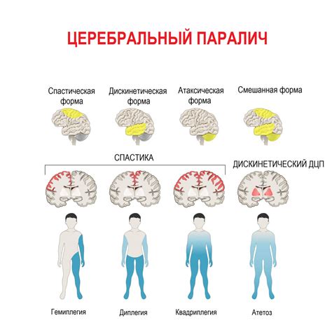Паралич