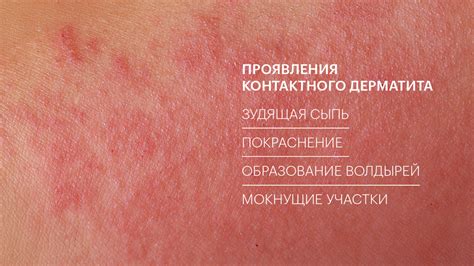 Аллергическая сыпь на лице: причины и симптомы