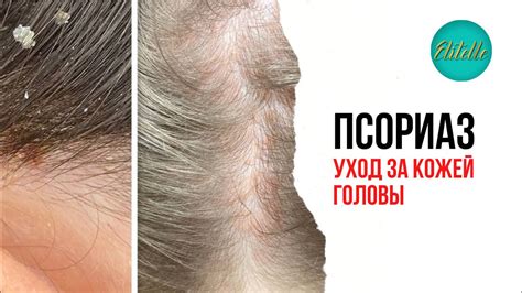Альтернативные способы устранения проблемы с акне на волосистой части головы
