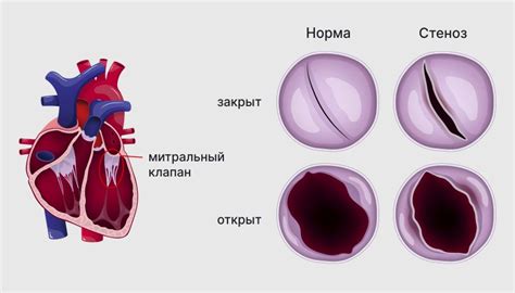Артериальный стеноз: причины и последствия