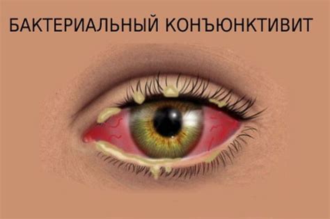 Бактериальный коньюктивит: важность препаратов и правильной терапии