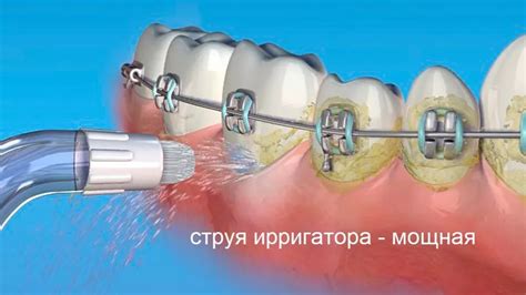 Важность использования ирригатора для улучшения здоровья полости рта: ключевые плюсы