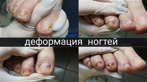 Важность своевременного лечения гнойных пальцев на ноге