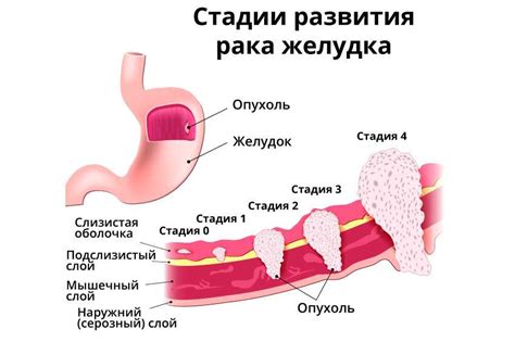 Взаимосвязь отсутствия антигена и риска развития рака желудка
