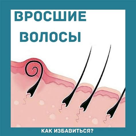 Влияние глубоко вросших волос на кожу