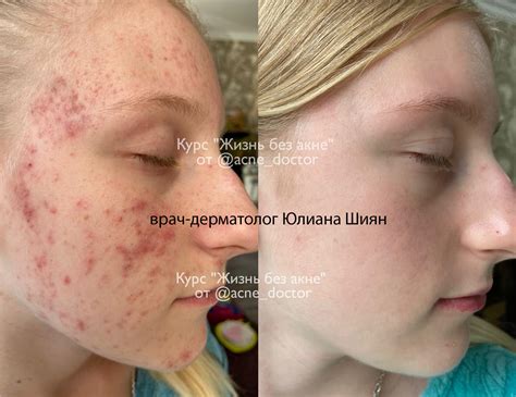 Влияние нарушенного питания на появление проблем с кожей
