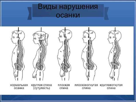 Влияние неправильной осанки на увеличение риска аварийных ситуаций