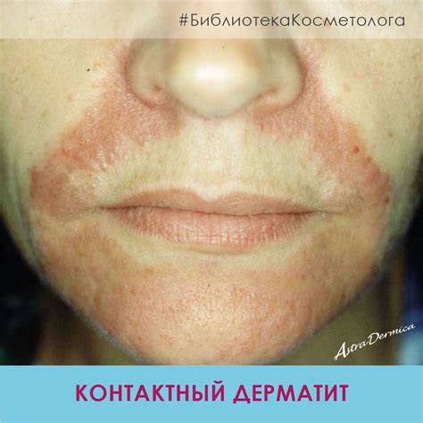 Влияние питания на скорость заживления повреждений после нанесения воска на лицо