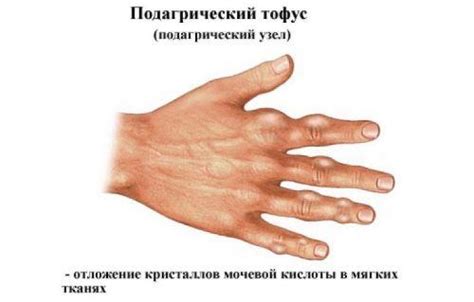 Влияние повторяющихся движений и перегрузок на появление шишек на коже руки