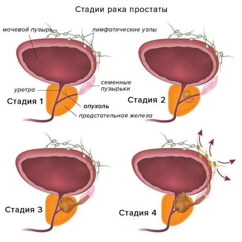 Влияние рака простаты на мужское здоровье и возможные способы предотвращения