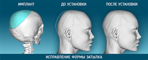Влияние формы черепа