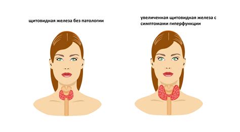 Воздействие стресса на работу щитовидной железы и уровень гормона тиреотропного вещества (ТТГ)