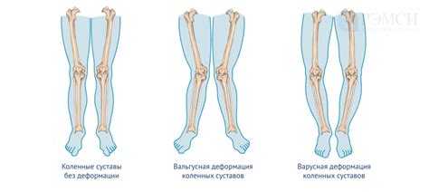 Возможность развития деформации колена