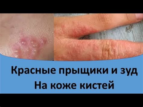 Возможные способы минимизации водянистых высыпаний на пальцах без оперативного вмешательства