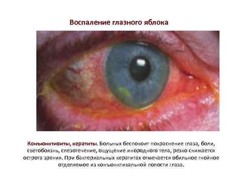 Воспаление глазного яблока