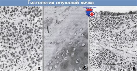 Гистохимия в онкологии
