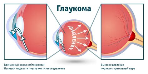 Глаукома: причины, симптомы и диагностика