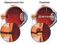 Глаукома вторичная: диагностика и лечение