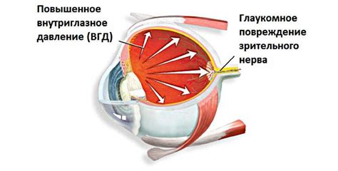 Глаукома вторичная: понятие, причины, симптомы