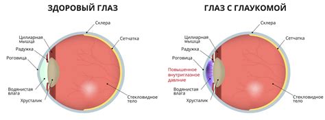 Глаукома глаза 2 степени