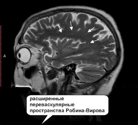 Глиоз резидуального характера: понятие и особенности