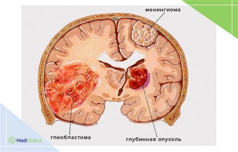 Глиома и глиобластома: