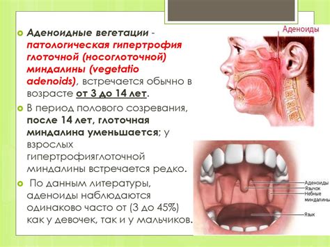 Гомеопатия в борьбе с гипертрофией нёбных миндалин у детей