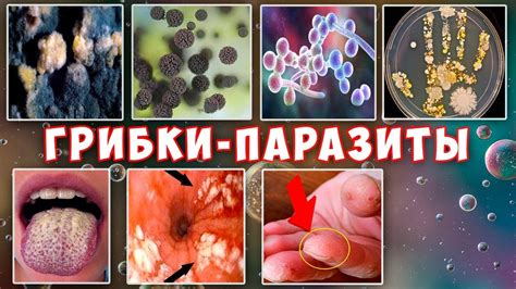 Грибковая инфекция: особенности поражения и лечение