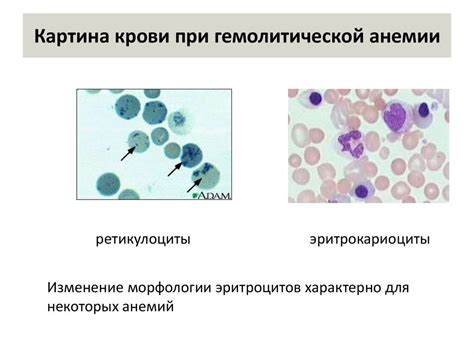Диагностика анемии гемолитической у взрослых: методы и исследования