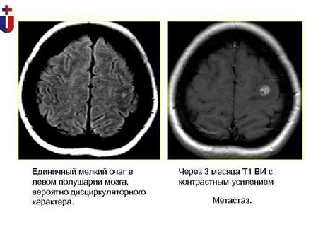 Диагностика глиоза дисциркуляторного характера