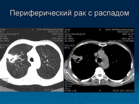 Диагностика глухого дыхания в легких