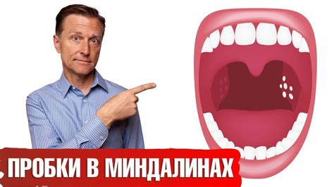 Диагностика гнойных шариков на гландах