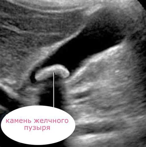Диагностика гомогенного содержимого желчного пузыря