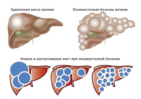 Диагностика гомогенного содержимого кисты
