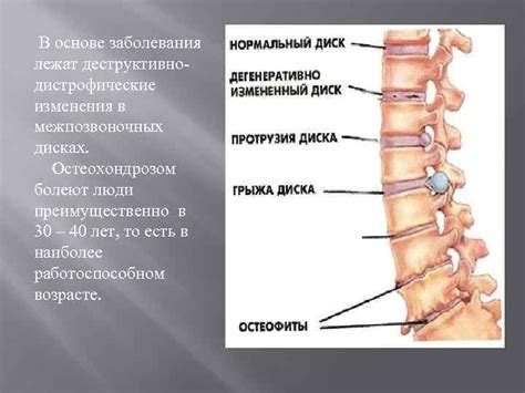 Диагностика нарушений в межпозвоночных дисках