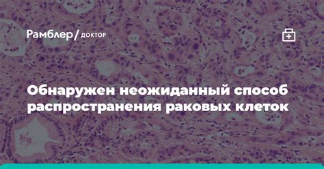 Диагностика распространения раковых клеток в нервной ткани при поражении простаты