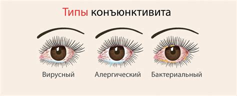 Длительное ношение контактных линз - возможный фактор
