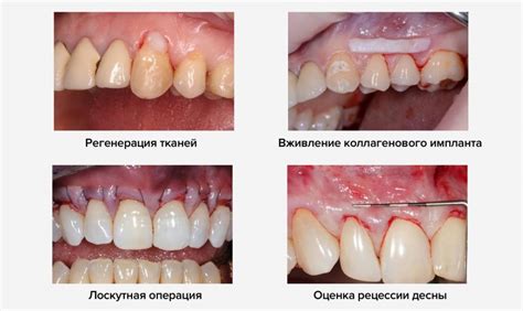 Домашние методы снятия опухоли десны