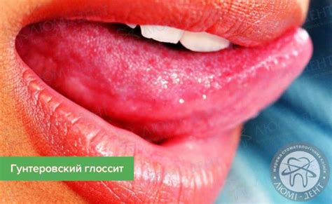 Значение глоссит языка