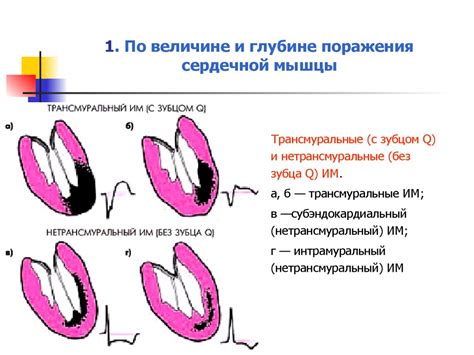 Значение электрокардиографии в обнаружении аномалий сердечной мышцы
