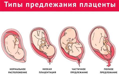 Зрелая плацента 1 степени: особенности и причины