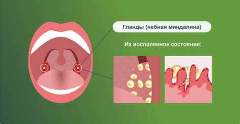 Инфекционные и бактериальные аспекты образования гноя на гландах при тонзиллите