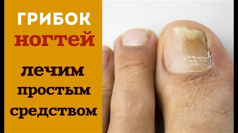 Использование препаратов от грибков