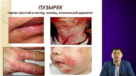 Использование специфических препаратов для облегчения кожной сыпи у детей