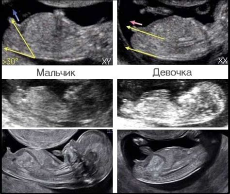 Использование ультразвукового скрининга для определения пола ребенка по визуальным признакам