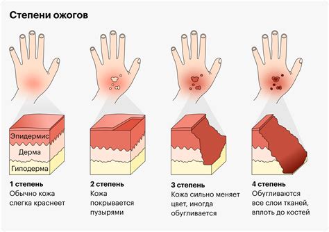 Использование холодной воды для облегчения ожога кипятком у ребенка: важность и правильная техника