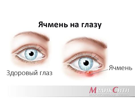 Истощение глазных желез