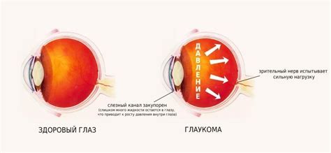 Каковы последствия повышенного глазного давления